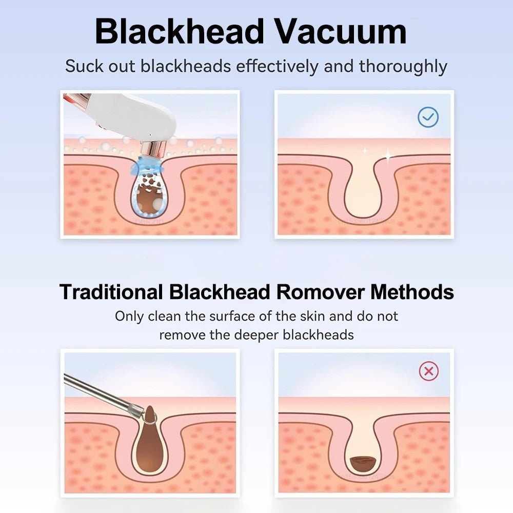 Pore Vacuum Blackhead Remover — Rechargeable Facial Pore Cleaner