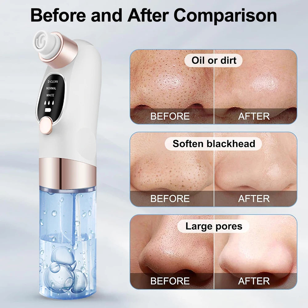 Pore Vacuum Blackhead Remover — Rechargeable Facial Pore Cleaner